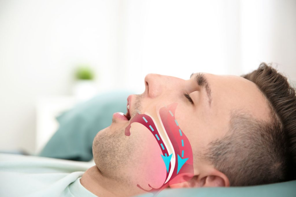 Apnea de sueño